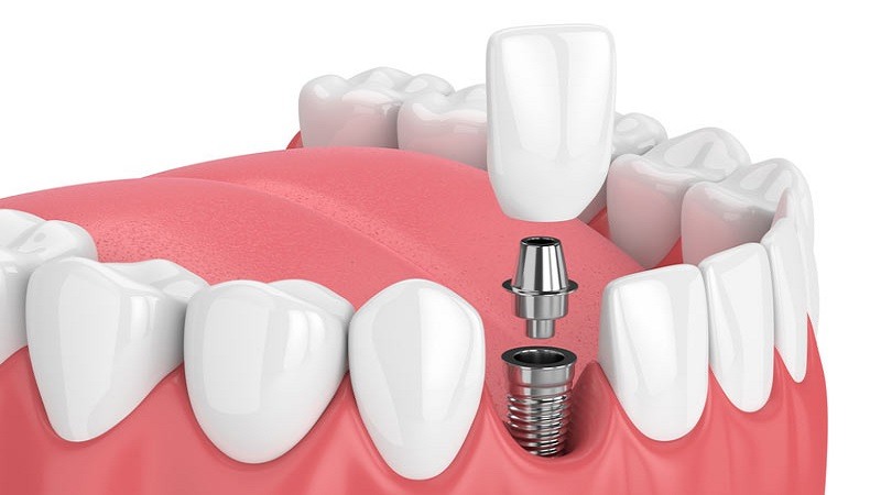 Implantes dentales: las dudas más frecuentes