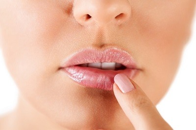Prevenir la aparición de herpes labial