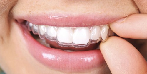 Ventajas de la ortodoncia invisalign