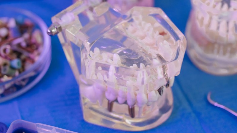 Principales tipos de prótesis dentales