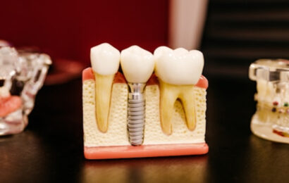 Implantes dentales en España: qué factores determinan el precio y cómo elegir una clínica Implantes dentales en España: qué factores determinan el precio y cómo elegir una clínica