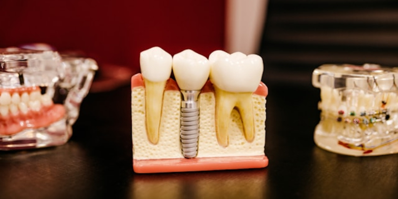Implantes dentales